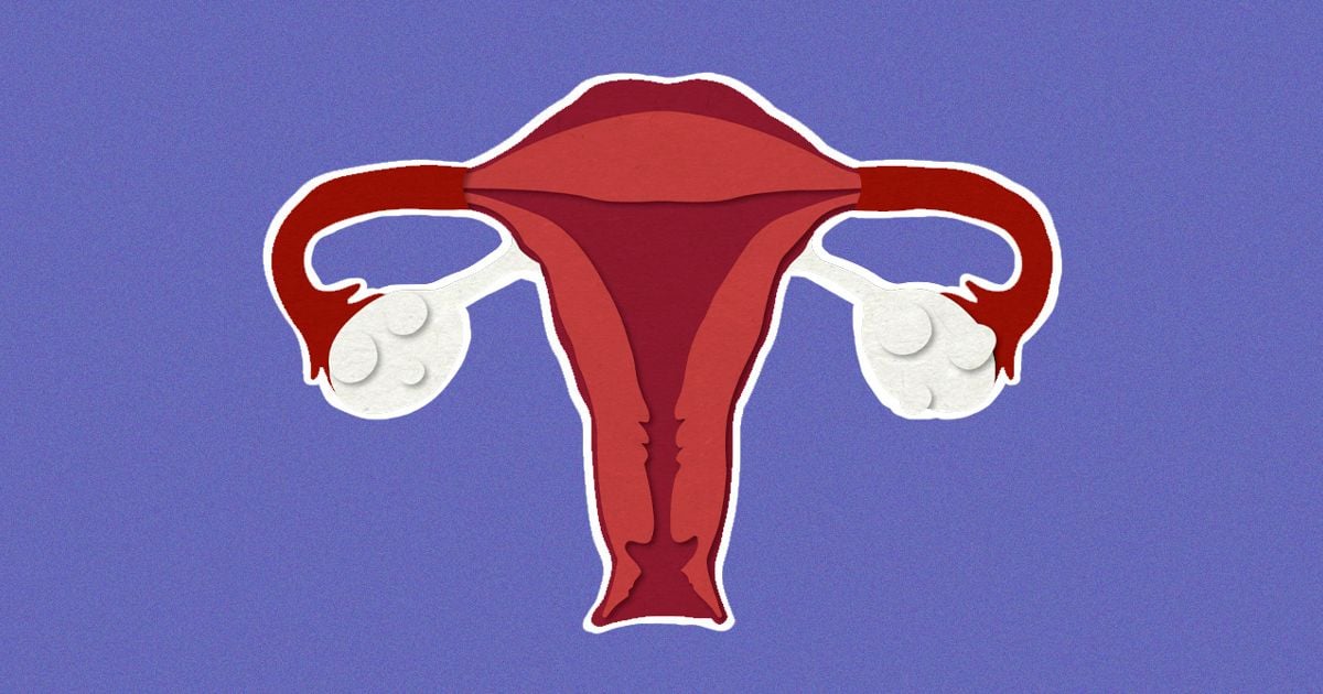 PCOS (Polycystic Ovary Syndrome)