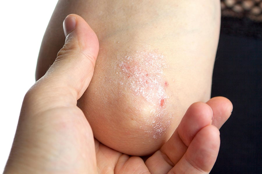 Psoriasis