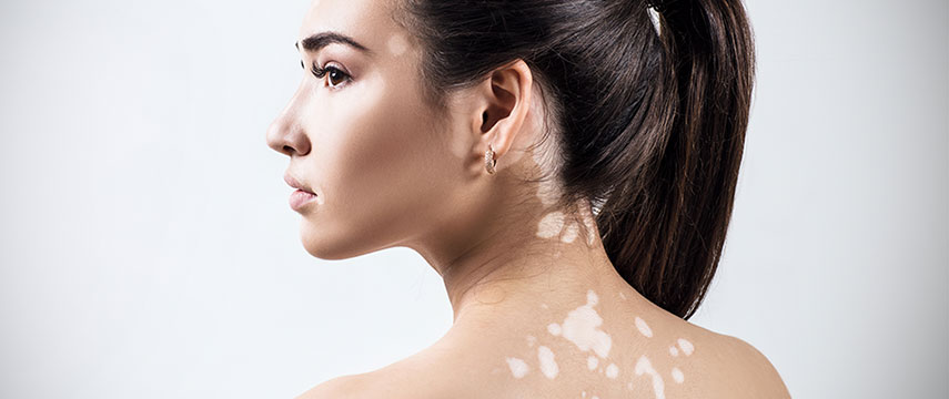 Vitiligo
