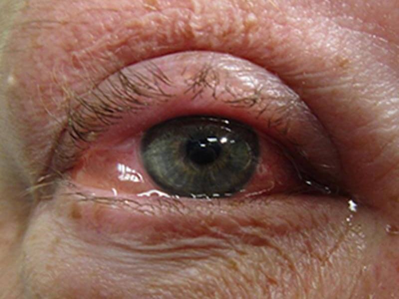 Conjunctivitis